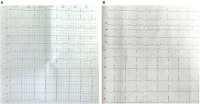 Case Report: Effective Treatment for Acute Chlorpyrifos Poisoning Complicated by a Non-ST-Segment Elevation Myocardial Infarction